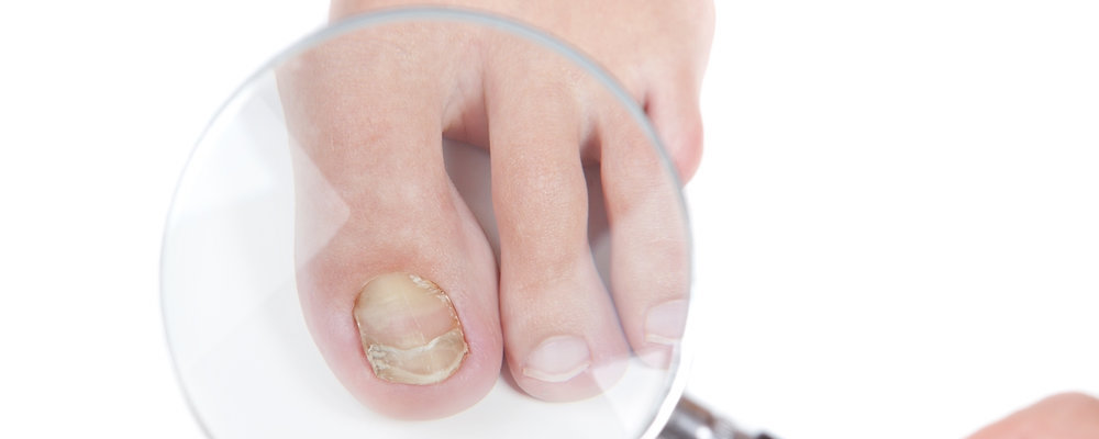 Toe Fungus Doctor St. Louis